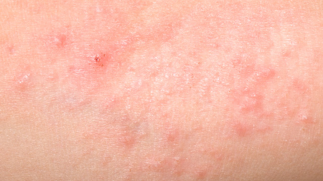 skin-care-and-heat-rash-skin-condition