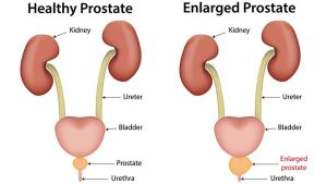 enlarged prostate