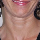 eliminate neck wrinkles