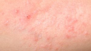 Skin care and Heat Rash skin condition