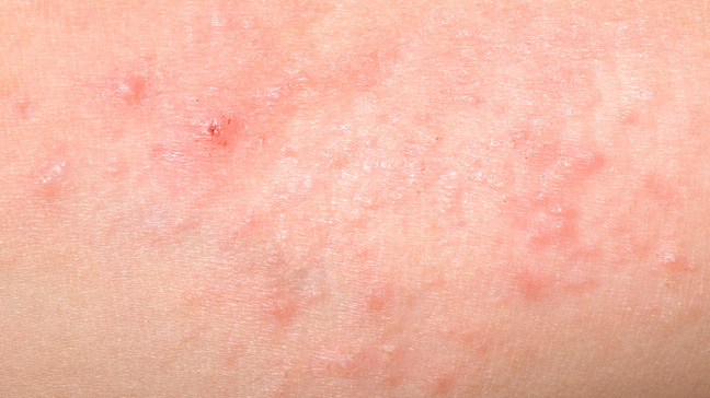 heat rash skin condition