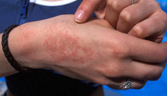 types of heat rash