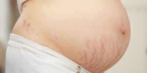 essential stretch marks info