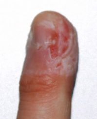 Harmful Effects Of Biting Your Fingernails