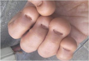 Harmful Effects Of Biting Your Fingernails 