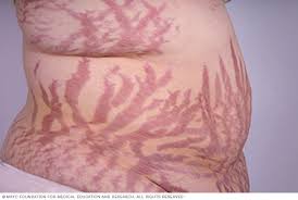 stretch marks causes