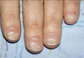 fingernails can indicate your health status