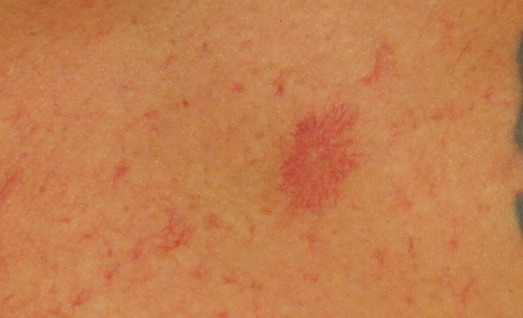 Liver Spots On Forearms